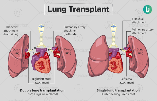 Kidney Failure